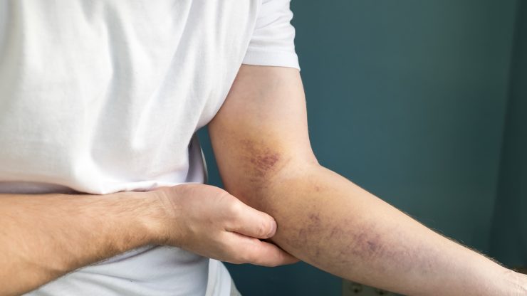 A person examines a bruised arm, reflecting concern and the need for compassionate legal support.